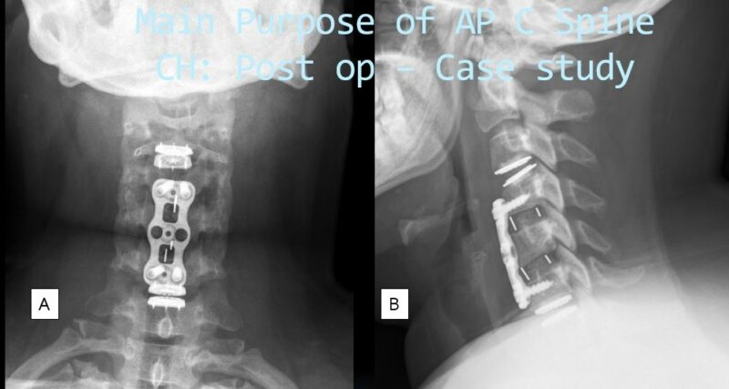 Cervical disk replacmeent1
