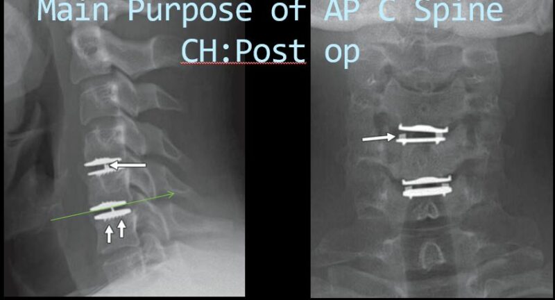 Cervical disk replacmeent