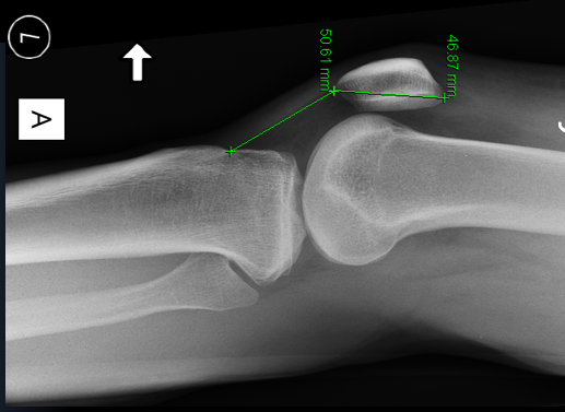 lateral knee 1