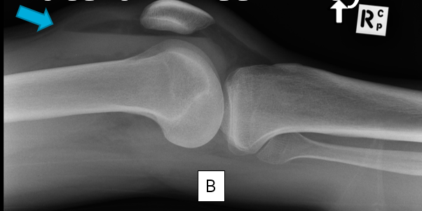 lateral knee2